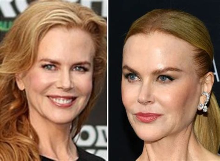 Nicole Kidman's Nose: The Cosmetic Evolution
